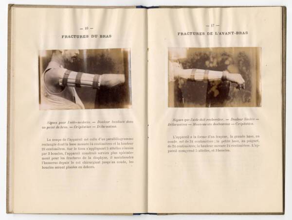 Double page sur les méthodes pour soigner des fractures au bras dans L’organisation des secours aux blessés industriels par le docteur Charles Bernard (de Roubaix), 1888.